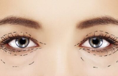 The Right Candidate Of Double Eyelid Surgery